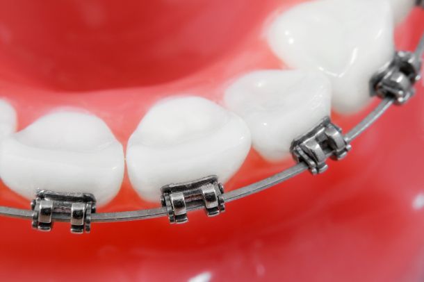 Brackets Details