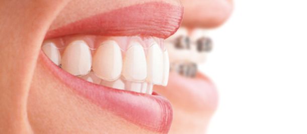 Zahnspangen für Erwachsene