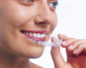 Invisalign Zahnspange: Funktionsweise