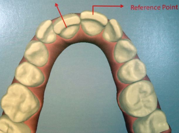 Zahnstellungskorrektur Beispiel