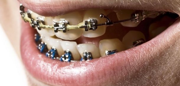 Zahnspange festsitzend Brackets