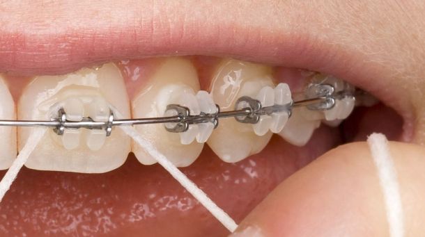 Transparente Brackets